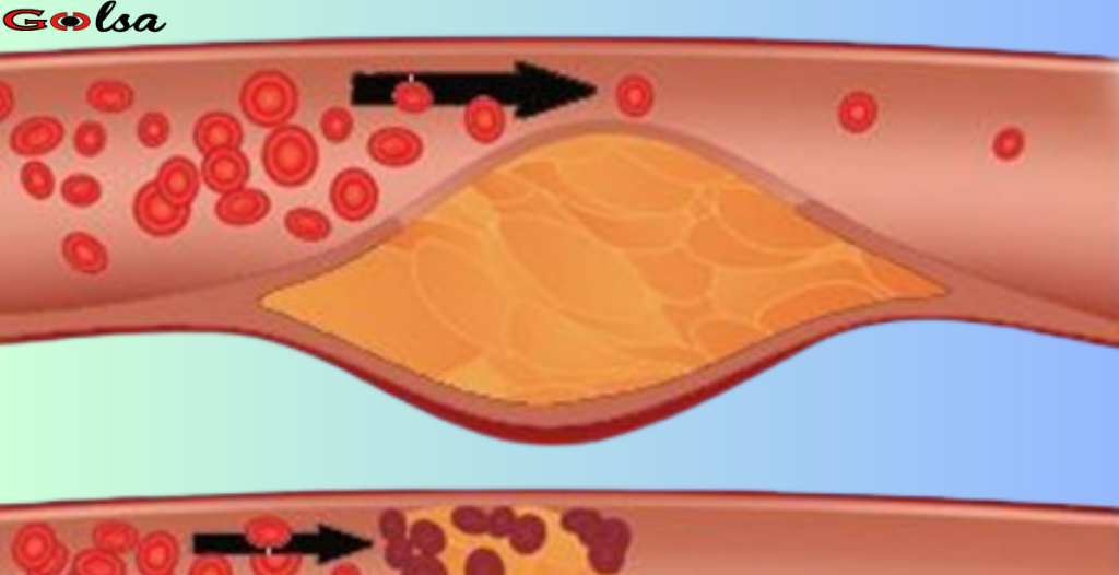 Here are 7 warning signs that indicate clogged arteries