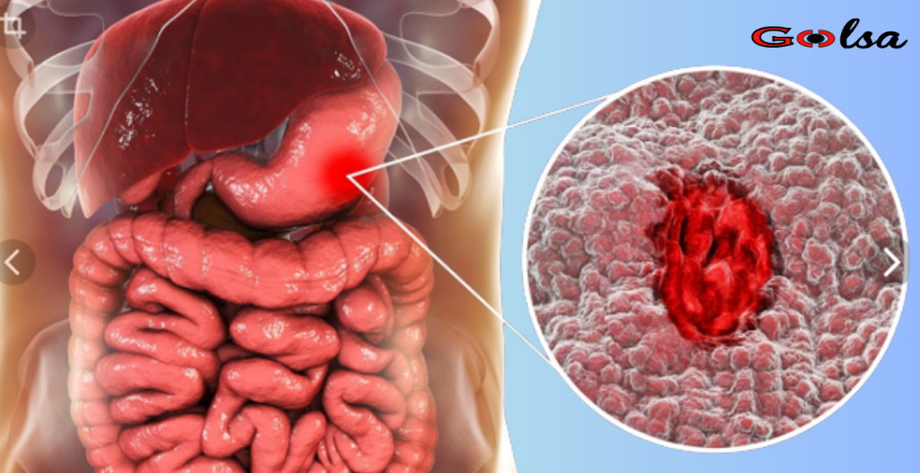 Stomach cancer: a deadly disease that is often overlooked