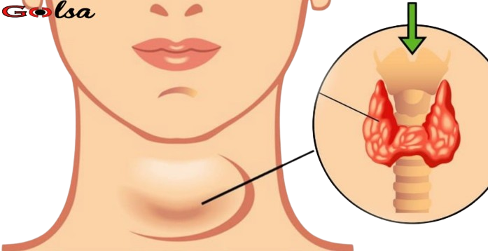 Thyroid problems: understanding symptoms, causes and treatment methods
