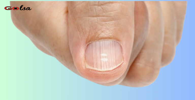 What Those Ugly Lines on Your Nails Mean About Your Health (And How to